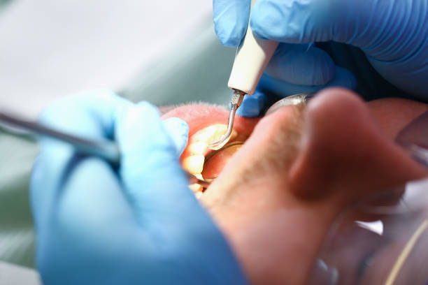 Best Emergency Dentist for Knocked-Out Tooth in Spanay, WA