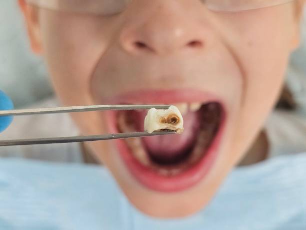 Best Pediatric Emergency Dentist in Spanay, WA